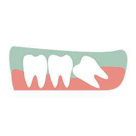 wisdome teeth